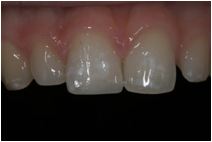 Broken Tooth Fixed