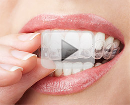 Teeth Whitening Video