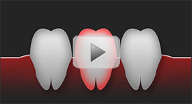 Tooth Replacement Video